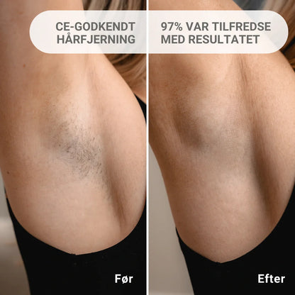 GlatLux™ | IPL - Permanent hårfjerner