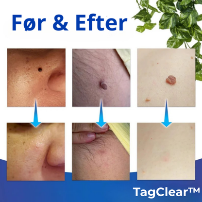 TagClear™ | Smertefri fjernelse af hudmærker