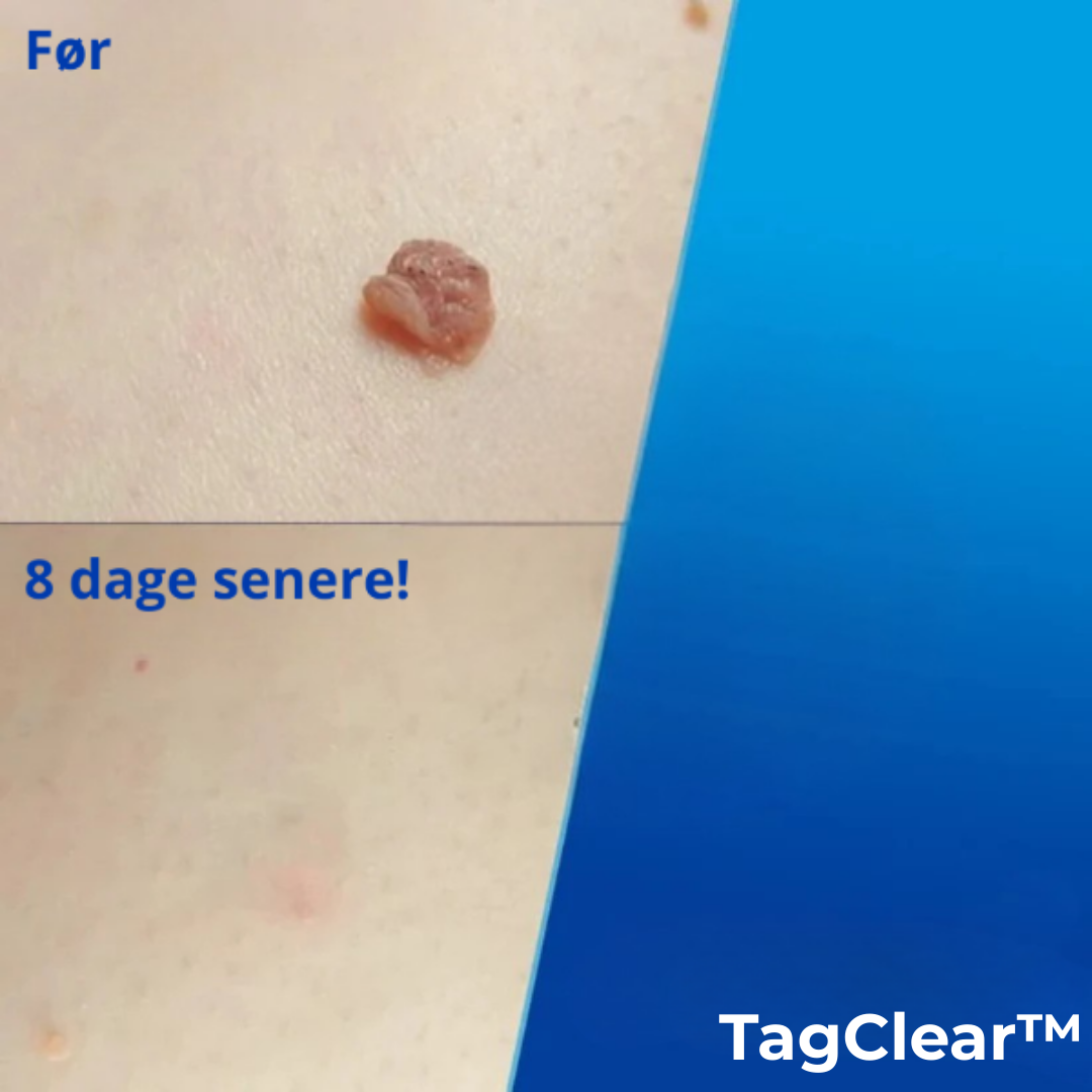 TagClear™ | Smertefri fjernelse af hudmærker